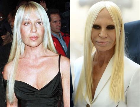 versace bad plastic surgery|Plastic Surgery Gone Wrong .